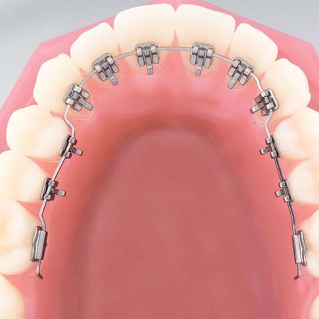 How lingual braces work