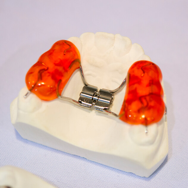 How TADs are used in orthodontics