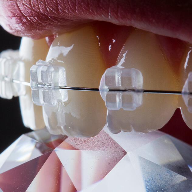 What are ceramic braces?