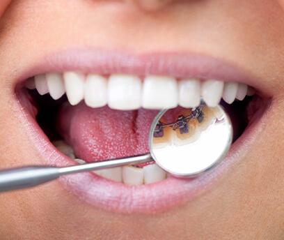 Lingual braces
