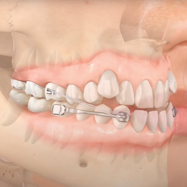 What is the Carriere® Motion Appliance?