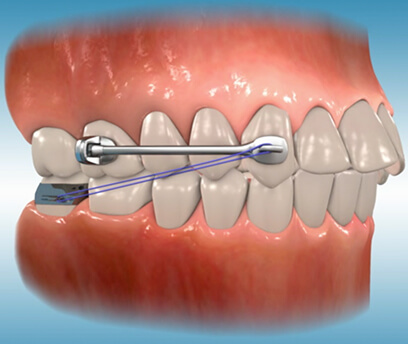 CARRIERE MOTION APPLIANCE (NEW)
